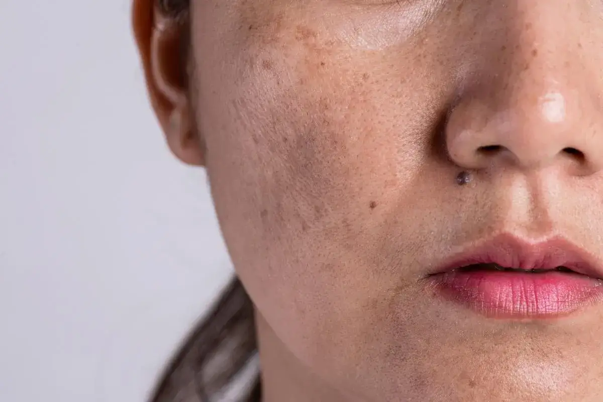 Primer plano de una cara con melasma y un peque&ntilde;o lunar sobre el labio superior, simulando un bigote.